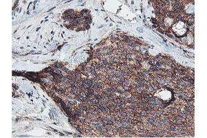 Immunohistochemical staining of paraffin-embedded Adenocarcinoma of Human breast tissue using anti-NPTN mouse monoclonal antibody. (NPTN antibody)
