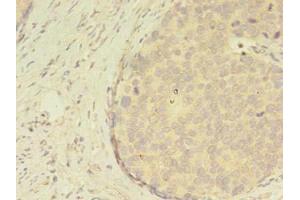 Immunohistochemistry of paraffin-embedded human gastric cancer using ABIN7144805 at dilution of 1:100 (ATXN7L3 antibody  (AA 51-347))