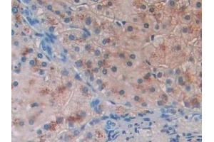 Detection of BACE2 in Human Liver cancer Tissue using Polyclonal Antibody to Beta Secretase 2 (BACE2)