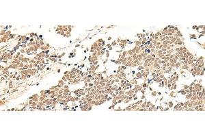 Immunohistochemistry of paraffin-embedded Human lung cancer tissue using GPR139 Polyclonal Antibody at dilution of 1:50(x200) (GPR139 antibody)