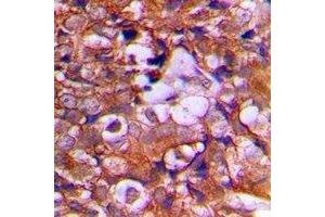 Immunohistochemical analysis of PTEN staining in human prostate cancer formalin fixed paraffin embedded tissue section.