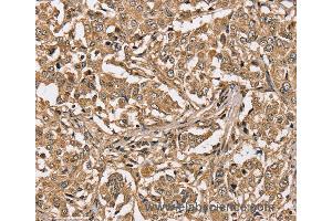 Immunohistochemistry of Human liver cancer using PPP1CC Polyclonal Antibody at dilution of 1:40 (PPP1CC antibody)