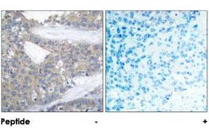 Imunohistochemical analysis of paraffin-embedded human breast carcinoma tissue using PXN polyclonal antibody . (Paxillin antibody)