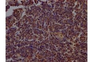 IHC image of ABIN7163739 diluted at 1:200 and staining in paraffin-embedded human lung cancer performed on a Leica BondTM system. (PARP1 antibody  (AA 324-541))
