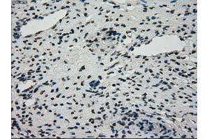 Immunohistochemical staining of paraffin-embedded Adenocarcinoma of breast tissue using anti-STK39 mouse monoclonal antibody. (STK39 antibody)