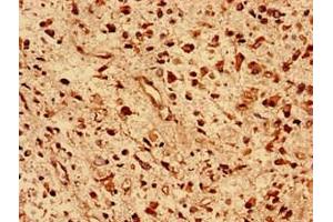 Immunohistochemistry analysis of human glioma using ABIN7150524 at dilution of 1:100 (DNAJB5 antibody  (AA 1-344))