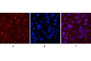 Immunofluorescence analysis of human breast cancer tissue. (Caspase 1 antibody  (Cleaved-Asp210))