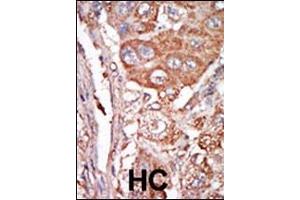 Formalin-fixed and paraffin-embedded human cancer tissue reacted with the primary antibody, which was peroxidase-conjugated to the secondary antibody, followed by DAB staining. (FGF4 antibody  (C-Term))