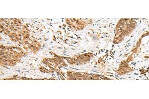 Immunohistochemistry of paraffin-embedded Human esophagus cancer tissue using NUP58 Polyclonal Antibody at dilution of 1:50(x200) (NUPL1 antibody)