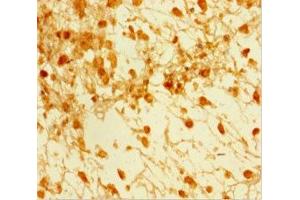 Immunohistochemistry of paraffin-embedded human melanoma using ABIN7160242 at dilution of 1:100 (SMAD5 antibody  (AA 1-209))