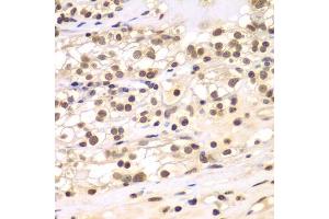 Immunohistochemistry of paraffin-embedded human kidney cancer using ULK4 antibody (ABIN5975557) at dilution of 1/100 (40x lens). (ULK4 antibody)