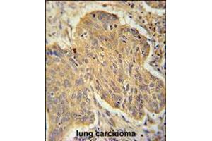 PSMD7 Antibody immunohistochemistry analysis in formalin fixed and paraffin embedded human lung carcinoma followed by peroxidase conjugation of the secondary antibody and DAB staining. (PSMD7 antibody  (C-Term))