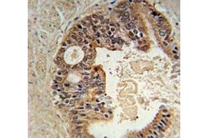 DYRK1A Antiboty immunohistochemistry analysis in formalin fixed and paraffin embedded human prostate carcinoma. (DYRK1A antibody  (AA 107-136))