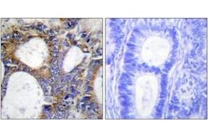 Immunohistochemistry analysis of paraffin-embedded human colon carcinoma tissue, using Collagen I alpha2 Antibody.