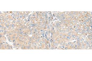 Immunohistochemistry of paraffin-embedded Human liver cancer tissue using CAMK2A Polyclonal Antibody at dilution of 1:55(x200) (CAMK2A antibody)