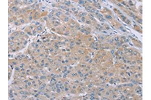 The image on the left is immunohistochemistry of paraffin-embedded Human liver cancer tissue using ABIN7192258(SAMD4B Antibody) at dilution 1/20, on the right is treated with synthetic peptide. (SAMD4B antibody)