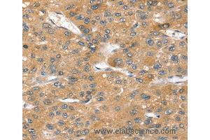 Immunohistochemistry of Human breast cancer using SORT1 Polyclonal Antibody at dilution of 1:40 (Sortilin 1 antibody)