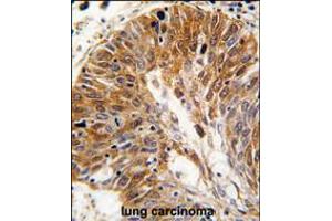 Formalin-fixed and paraffin-embedded human lung carcinoma tissue reacted with PSMD11 antibody , which was peroxidase-conjugated to the secondary antibody, followed by DAB staining. (PSMD11 antibody  (C-Term))