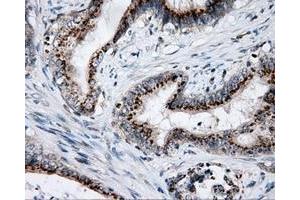 Immunohistochemical staining of paraffin-embedded Adenocarcinoma of colon tissue using anti-LIPG mouse monoclonal antibody. (LIPG antibody)