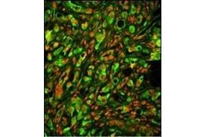 Immunofluorescence analysis of PTP4A2 Antibody (Center) with paraffin-embedded human prostate carcinoma tissue. (PTP4A2 antibody  (AA 32-59))