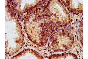 IHC image of ABIN7157862 diluted at 1:200 and staining in paraffin-embedded human prostate cancer performed on a Leica BondTM system. (Laminin antibody  (AA 974-1162))