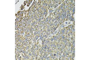 Immunohistochemistry of paraffin-embedded human liver cancer using RASSF1 antibody (ABIN6293520) at dilution of 1:100 (40x lens). (RASSF1 antibody)