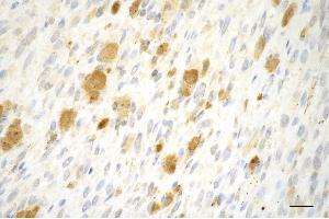 Immunohistochemistry was performed on paraffin-embedded human breast carcinoma using cadherin 1 antibody (ABIN7797818), 1:150).