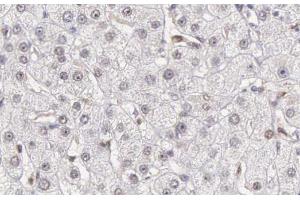 ABIN6266502 at 1/200 staining human liver carcinoma tissue sections by IHC-P. (Caspase 10 antibody)