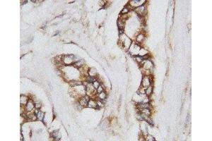 IHC-P: CDC42 antibody testing of human breast cancer tissue