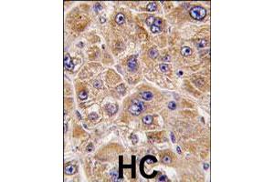 Formalin-fixed and paraffin-embedded human hepatocellular carcinoma reacted with ALDH5A1 polyclonal antibody  , which was peroxidase-conjugated to the secondary antibody, followed by DAB staining.