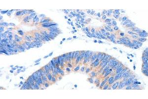 Immunohistochemistry of paraffin-embedded Human colon cancer tissue using MUC3A Polyclonal Antibody at dilution 1:60 (MUC3A antibody)