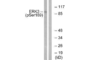 Immunohistochemistry analysis of paraffin-embedded human breast carcinoma tissue using ERK3 (Phospho-Ser189) antibody. (MAPK6 antibody  (pSer189))