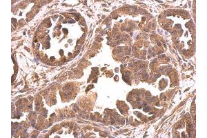 IHC-P Image EIF4A2 antibody detects EIF4A2 protein at cytosol on human ovarian carcinoma by immunohistochemical analysis. (EIF4A2 antibody)