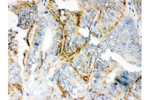 Anti-PKLR Picoband antibody, IHC(P) IHC(P): Human Intestinal Cancer Tissue (PKLR antibody  (C-Term))