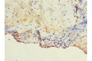 Immunohistochemistry of paraffin-embedded human breast cancer using ABIN7172926 at dilution of 1:100 (TM4SF1 antibody  (AA 115-161))