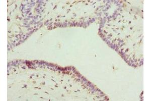 Immunohistochemistry of paraffin-embedded human breast cancer using ABIN7156859 at dilution of 1:100 (IL22RA2 antibody  (AA 22-231))