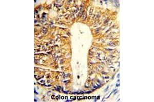 Formalin-fixed and paraffin-embedded human colon carcinoma reacted with Villin-1 Antibody (N-term), which was peroxidase-conjugated to the secondary antibody, followed by DAB staining. (Villin 1 antibody  (N-Term))