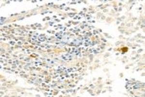 Immunohistochemistry analysis of paraffin-embedded human lymph node using PARP1 (ABIN7075114) at dilution of 1: 750 (PARP1 antibody  (cleaved))