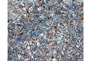 Immunohistochemical staining of paraffin-embedded Carcinoma of liver tissue using anti-LIPG mouse monoclonal antibody. (LIPG antibody)
