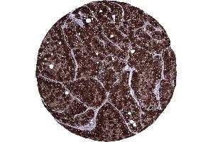 Acinar cell carcinoma of the pancreas exhibiting a strong CELA3B immunostaining of all tumor cells (Recombinant Elastase 3B antibody  (AA 82-238))
