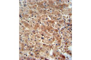 AS antibody (N-term) (ABIN654956 and ABIN2844596) immunohistochemistry analysis in formalin fixed and paraffin embedded human hepatocarcinoma followed by peroxidase conjugation of the secondary antibody and DAB staining. (ASAP3 antibody  (N-Term))