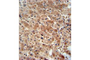 AS antibody (N-term) (ABIN654956 and ABIN2844596) immunohistochemistry analysis in formalin fixed and paraffin embedded human hepatocarcinoma followed by peroxidase conjugation of the secondary antibody and DAB staining.