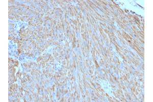 Formalin-fixed, paraffin-embedded human GIST stained with CD117 Mouse Monoclonal Antibody (C117/370). (KIT antibody)