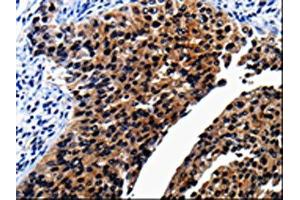 The image on the left is immunohistochemistry of paraffin-embedded Human renal cancer tissue using ABIN7189819(AP1B1 Antibody) at dilution 1/25, on the right is treated with synthetic peptide. (AP1B1 antibody)