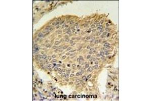 TPC6A Antibody (N-term) (ABIN651480 and ABIN2840261) IHC analysis in formalin fixed and paraffin embedded human lung carcinoma followed by peroxidase conjugation of the secondary antibody and DAB staining. (TRAPPC6A antibody  (N-Term))