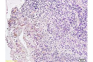 Formalin-fixed and paraffin embedded Human brain glioma labeled with Anti-PDGFRB Polyclonal Antibody, Unconjugated (ABIN726635) at 1:200 followed by conjugation to the secondary antibody and DAB staining (PDGFRB antibody  (AA 981-1066))