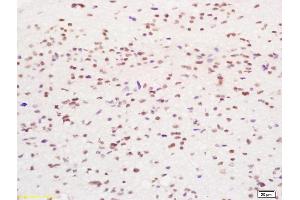 Formalin-fixed and paraffin embedded human glioma tissue labeled with Anti-Phospho-YB1(Ser102) Polyclonal Antibody, Unconjugated (ABIN746918) at 1:200 followed by conjugation to the secondary antibody and DAB staining (YBX1 antibody  (pSer102))