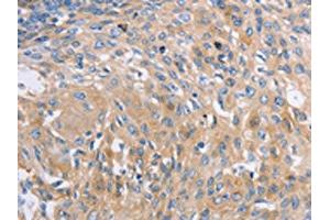 The image on the left is immunohistochemistry of paraffin-embedded Human cervical cancer tissue using ABIN7191576(NBEA Antibody) at dilution 1/60, on the right is treated with synthetic peptide. (Neurobeachin antibody)