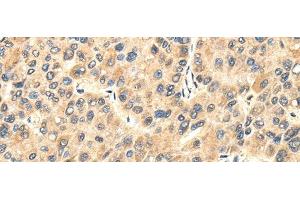 Immunohistochemistry of paraffin-embedded Human liver cancer tissue using TWIST2 Polyclonal Antibody at dilution 1:35