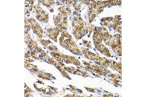 Immunohistochemistry of paraffin-embedded human liver cancer using SCFD1 Rabbit pAb (ABIN6132633, ABIN6147418, ABIN6147419 and ABIN6224809) at dilution of 1:200 (40x lens). (SCFD1 antibody  (AA 373-642))